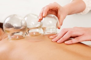 Cupping photo, Colorado Springs acupuncturist