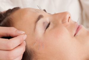 Cosmetic Acupuncture